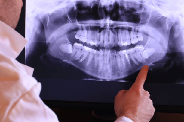Best Emergency Tooth Extraction in Sandpoint, ID